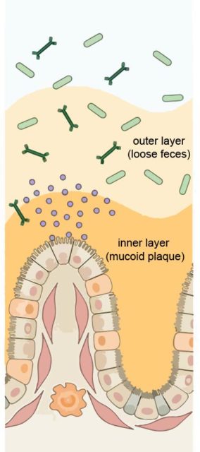 Mucoid Plaque Lining Inside Colon