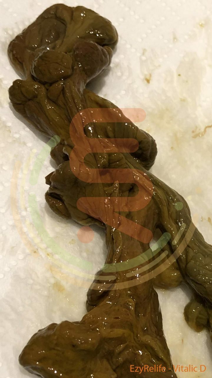 the unwanted waste - mucoid plaque